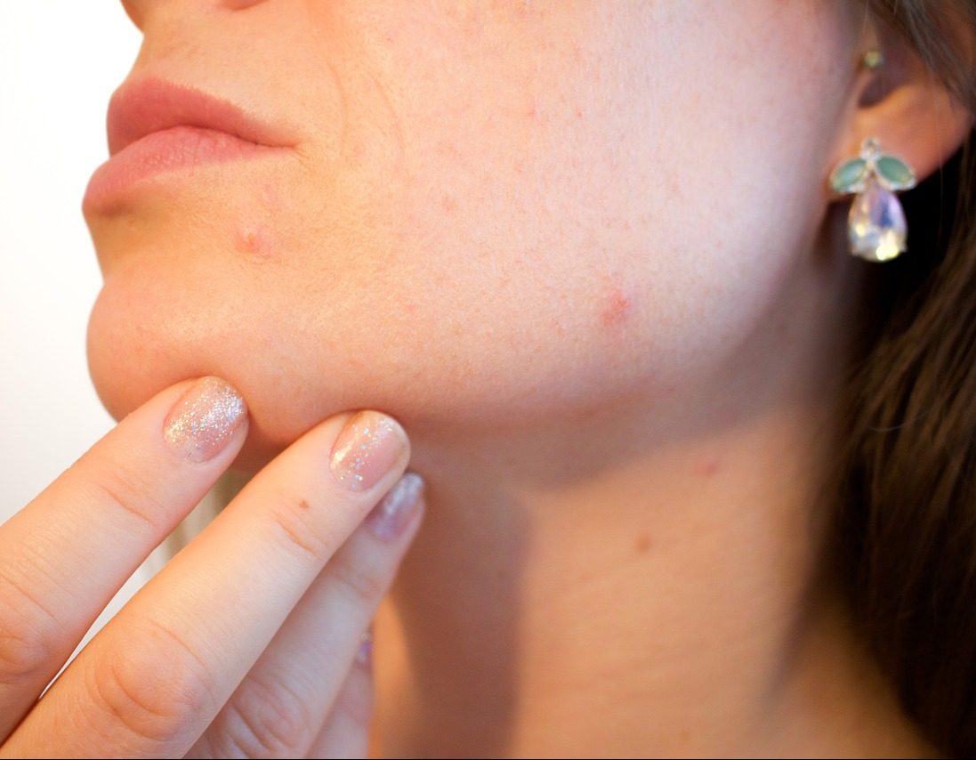 Tips tegen acne